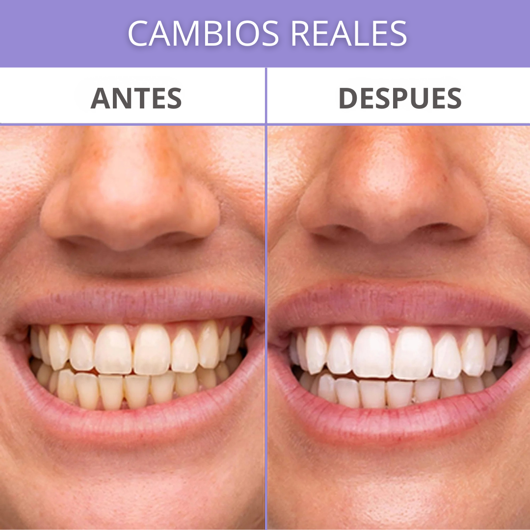 SmileUP Pro Blanqueador de dientes
